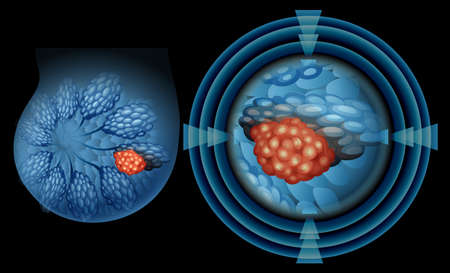 Position of breast cancer	 illustration