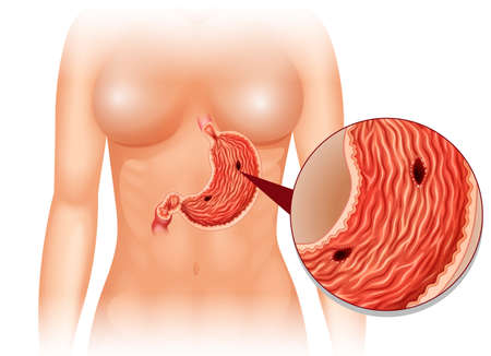 Stomach Ulcer diagram in woman illustrationのイラスト素材