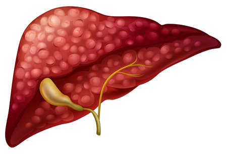 Sclerosis cancer in human illustrationのイラスト素材