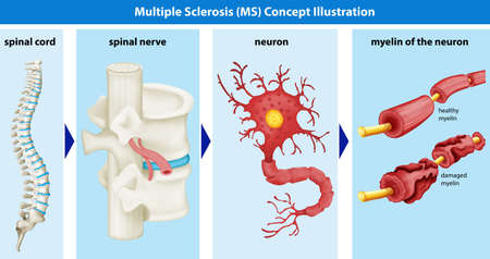 Diagram showing multiple sclerosis concept illustrationのイラスト素材