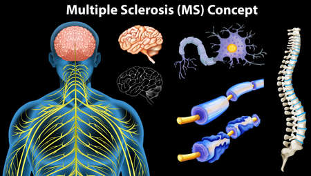 Diagram showing multiple sclerosis concept illustrationのイラスト素材