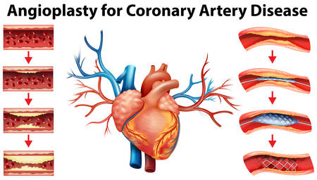 Diagram showing angioplasty for coronary artery disease illustrationのイラスト素材