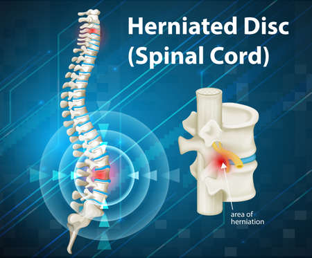Diagram showing herniated Disc illustrationのイラスト素材