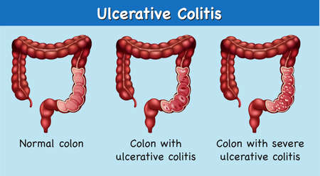 Diagram showing ulceration colitis illustration isolated on plain background.のイラスト素材