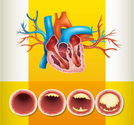 Heart anatomy and fat in vein illustrationのイラスト素材