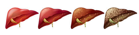 Different stages of human liver illustrationのイラスト素材