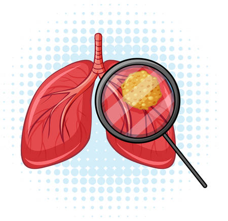 Cancer in human lungs illustrationのイラスト素材