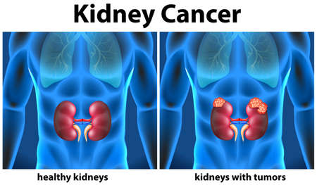 Diagram showing kidney cancer in human illustration