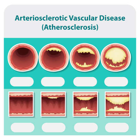 Diagram showing arteriosclerotic veascular disease illustrationのイラスト素材