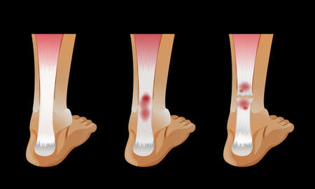 Diagram showing broken bone in human foot illustrationのイラスト素材