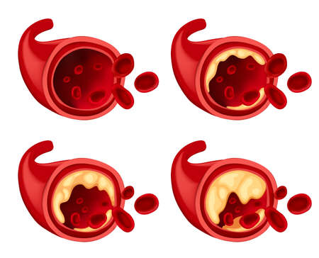 Diagram showing fat in blood illustrationのイラスト素材