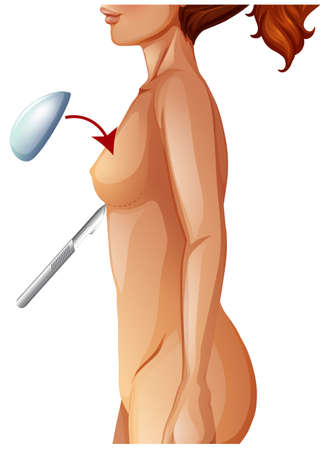 A Human Anatomy Breast Augmentation illustrationのイラスト素材