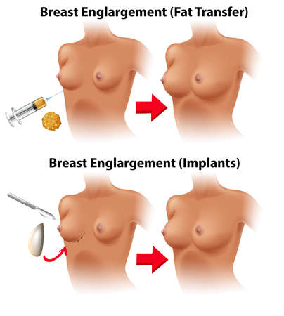 A Vector of Breast Surgery illustrationのイラスト素材