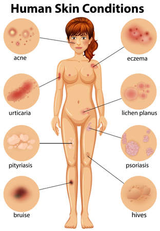 A Human Anatomy of Human Skin Condition illustrationのイラスト素材