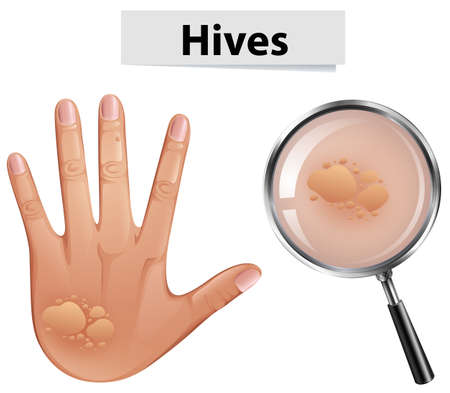 A Vector of Hives on Human Skin illustrationのイラスト素材