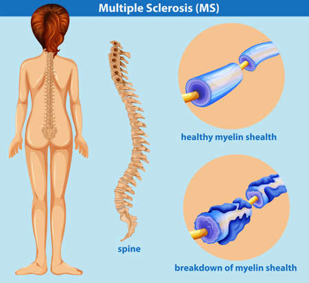 An Education Poster of Sclerosis illustrationのイラスト素材