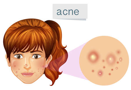 A Young Lady Acne on Face illustrationのイラスト素材