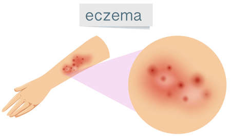A Vector of Eczema on Skin illustrationのイラスト素材