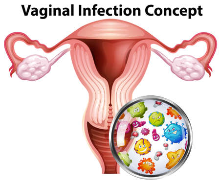 Vaginal infection bacteria concept illustrationのイラスト素材