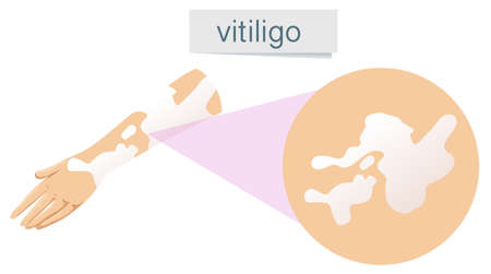 A Vector of Vitiligo on Skin illustrationのイラスト素材