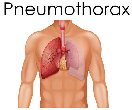 A Human Anatomy of Pneumothorax  illustrationのイラスト素材