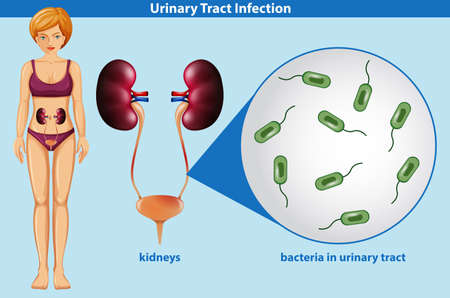 Human Anatomy of Urinary Tract Infection illustrationのイラスト素材