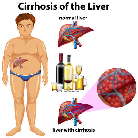 Cirrhosis of the Liver illustrationのイラスト素材
