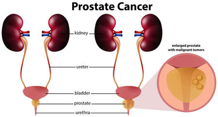 Prostate Cancer on White Background illustration