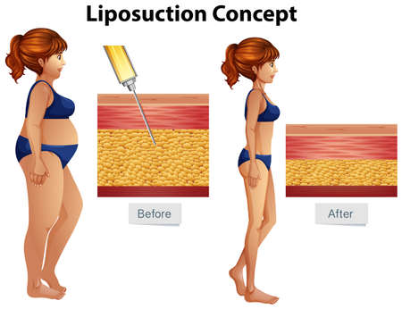 Human Liposuction Concept diagram illustrationのイラスト素材
