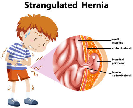 Boy with strangulated hernia on diagram illustrationのイラスト素材