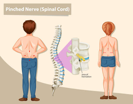 Diagram showing pinched nerve in human  illustrationのイラスト素材