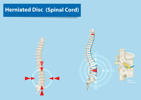 Diagram showing herniated disc in human illustrationのイラスト素材