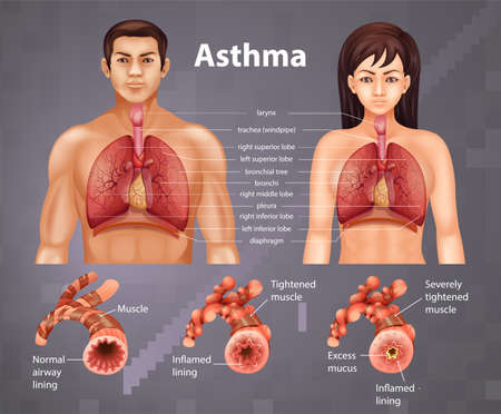 Comparison of healthy lung and Asthmatic lung illustrationのイラスト素材