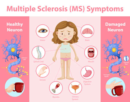 Multiple sclerosis (MS) symptoms information infographic illustrationのイラスト素材