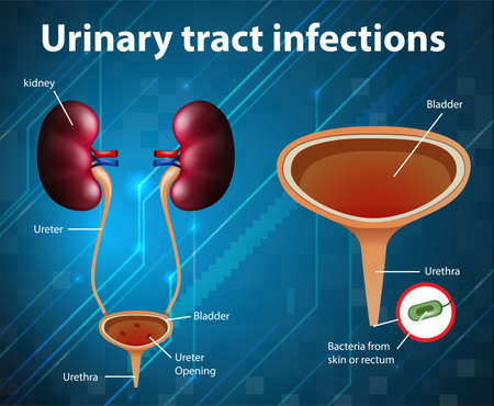 Informative illustration of urinary tract infections illustrationのイラスト素材