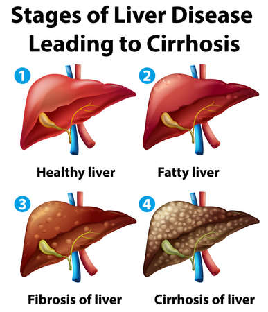 Stages of liver disease leading to Cirrhosis illustrationのイラスト素材