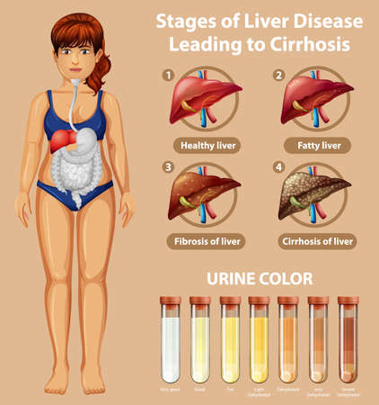 Stages of liver disease leading to Cirrhosis illustrationのイラスト素材