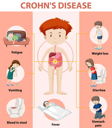 Medical infographic of Crohn's Disease illustrationのイラスト素材