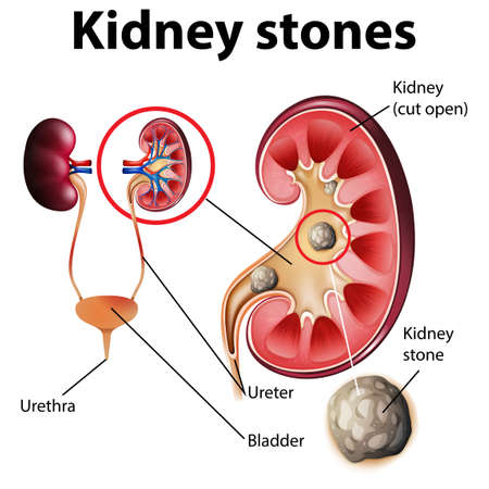 Informative illustration of kidney stones illustrationのイラスト素材