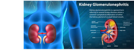 Medical infographic of kidney glomerulosclerosis illustrationのイラスト素材