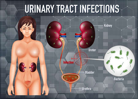 Informative illustration of urinary tract infections illustrationのイラスト素材