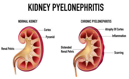 Informative illustration of Pyelonephritis illustrationのイラスト素材