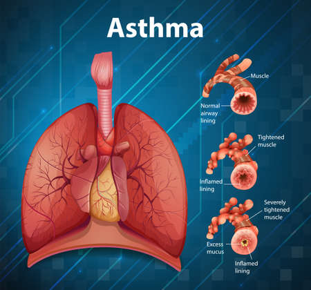 Comparison of healthy lung and Asthmatic lung illustrationのイラスト素材