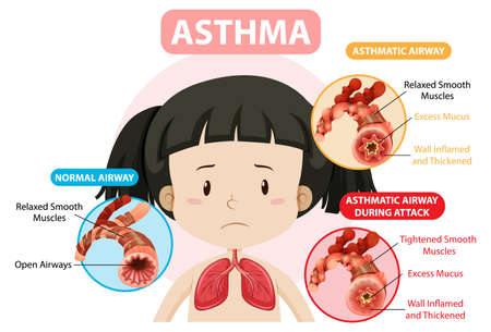Asthma diagram with normal airway and asthmatic airway illustrationのイラスト素材