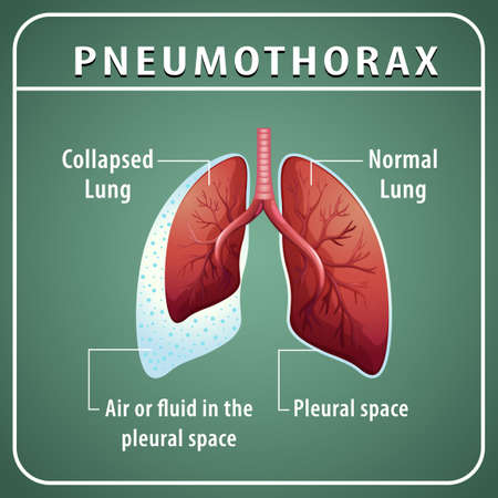 Pneumothorax diagram with collapsed lung and normal lung illustrationのイラスト素材