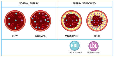 Types of Cholesterol HDL and LDL illustrationのイラスト素材