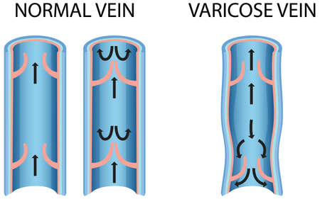 A comparison of normal vein with varicose vein illustrationのイラスト素材