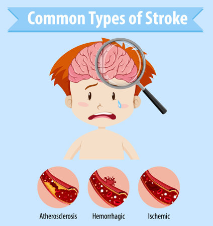 Human with common types of stroke illustrationのイラスト素材