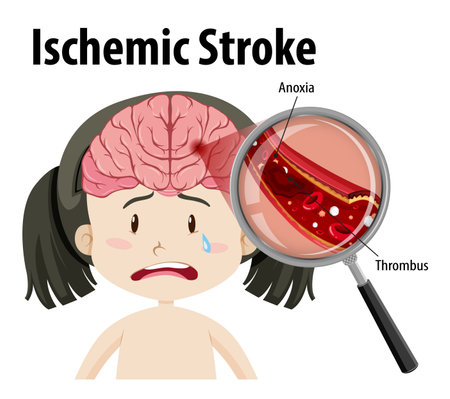 Human with Ischemic stroke illustrationのイラスト素材