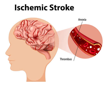 Human with Ischemic stroke illustrationのイラスト素材